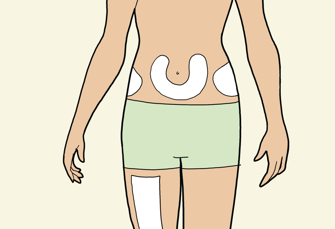 05_5  insulin injection sites